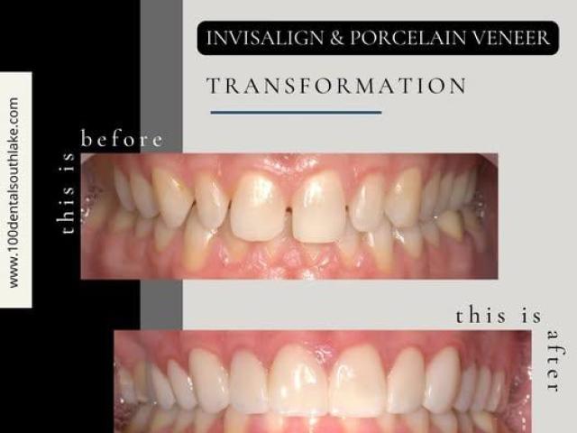 Root Canals in Southlake