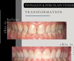 Root Canals in Southlake