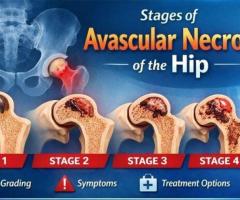 Stages of Avascular Necrosis Hip – Symptoms & Treatment