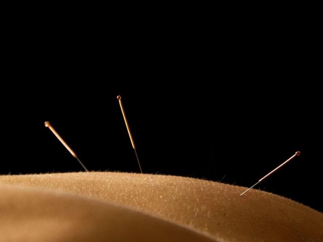 Best Acupuncturist in San Mateo, CA