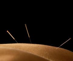 Best Acupuncturist in San Mateo, CA