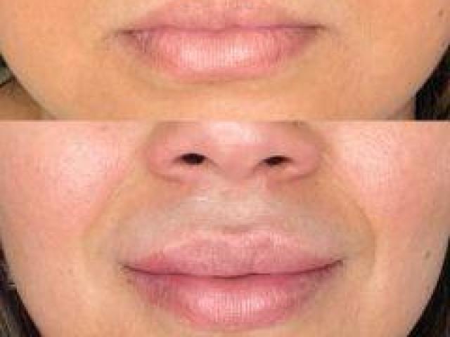 Best Laser Hair Removal NYC