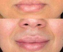 Best Laser Hair Removal NYC