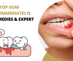 Tooth Implant Dentist in Foster City