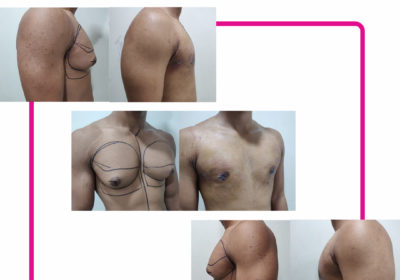 20-5-22-before-after-poster-copy-1