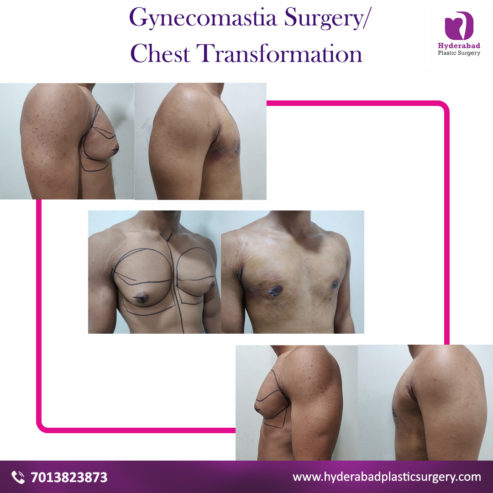 Best Gynecomastia Surgery in Hyderabad
