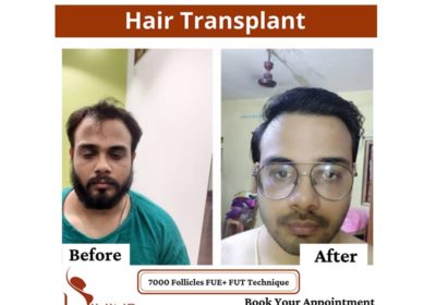 hair-transplant