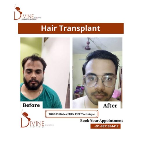Hair Transplant In Delhi , Gurgaon (India) | Best Doctor & Surgery