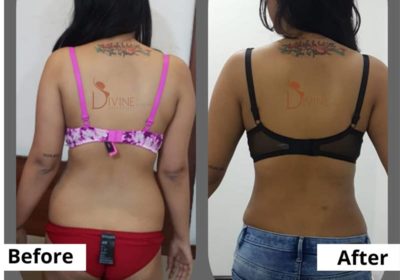 Liposuction-Surgery