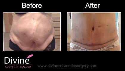 Tummy Tuck Surgery In Noida – Cost, Procedure & Recovery