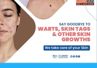 clear-skin-10-warts
