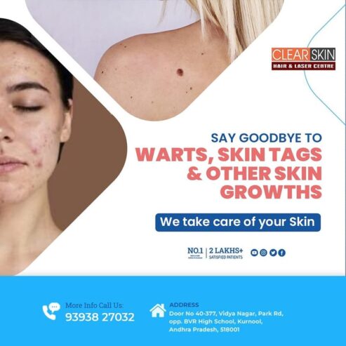 Wart Removal Treatment in kurnool