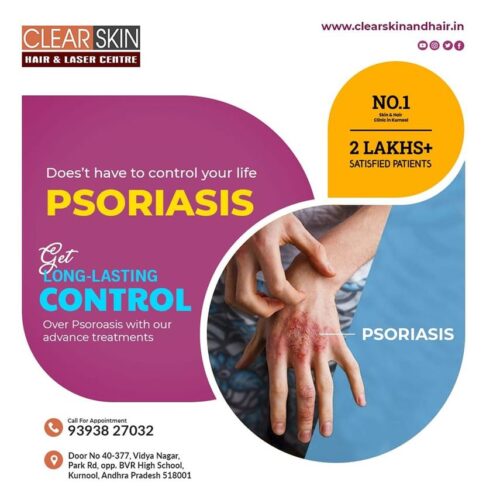 Psoriasis Treatment in india