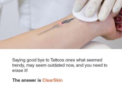 tattoo-removal