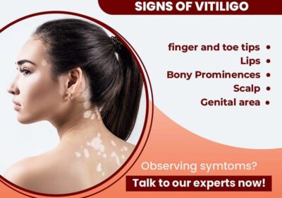 clear-skin-17-vitiligo