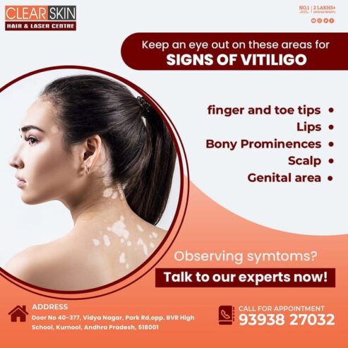 Best Vitiligo Treatment In Kurnool || Laser Treatment || Skin Care || Painfree || Clearskin and Haircare Kurnool