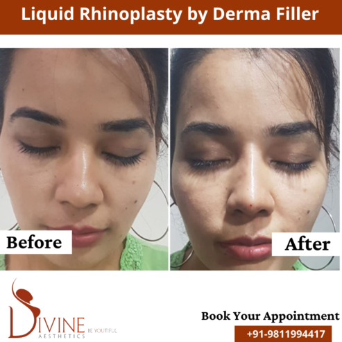 Rhinoplasty – Nose Plastic Surgery – Nose Job
