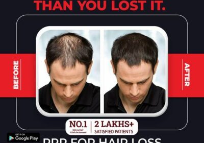 PRP-for-hair