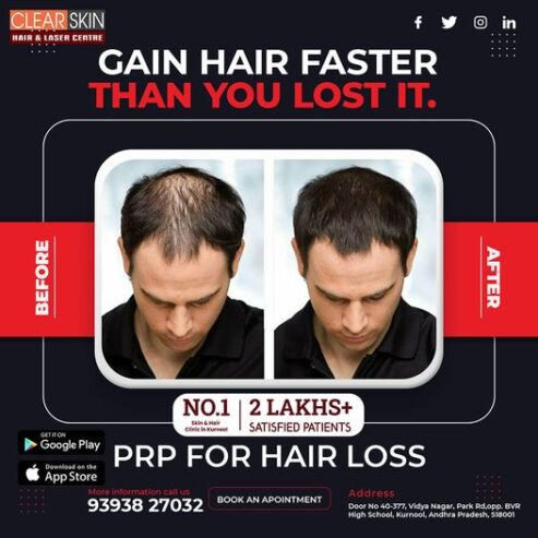 PRP hair Treatment in bangalore