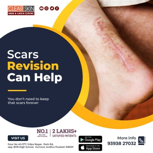 Best Scar Revision Treatment in Andhra Pradesh AP