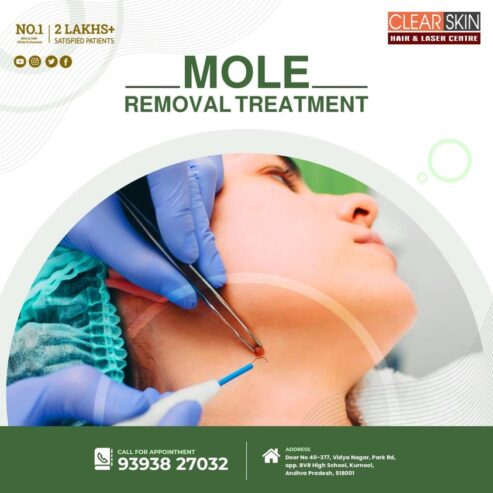 best Advanced Mole Treatment In Andhra Pradesh AP
