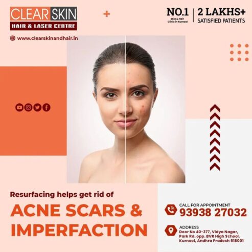Best Advance Scar Revision Treatment in bangalore