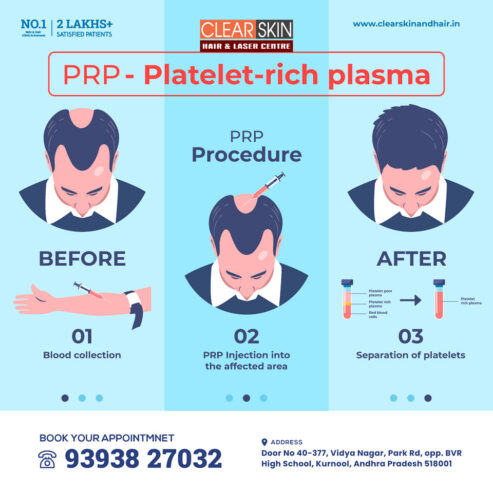 PRP hair Treatment in bangalore