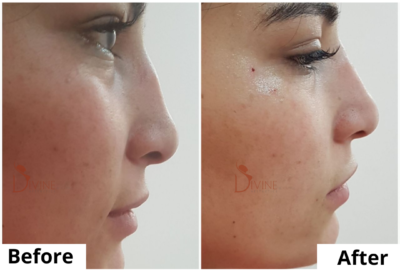 nose-rhinoplasty-2