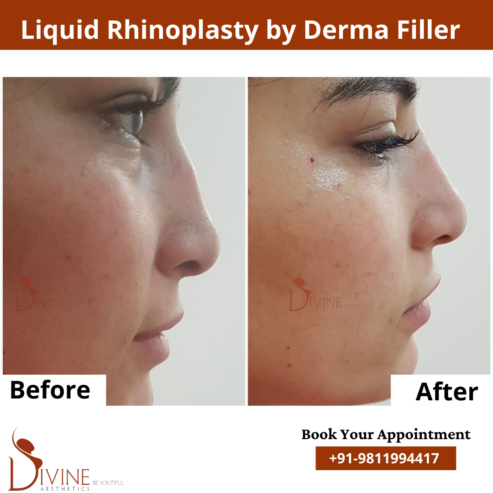 Nose Plastic Surgery In Delhi – Rhinoplasty In Delhi