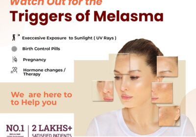 Melasma