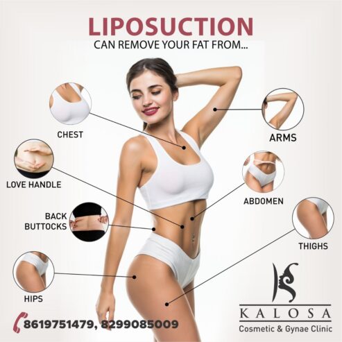 Liposuction Surgery: Free Yourself From Unwanted Fat