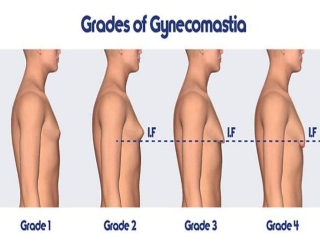 Reclaim Your Confidence with Gynecomastia Surgery in Delhi
