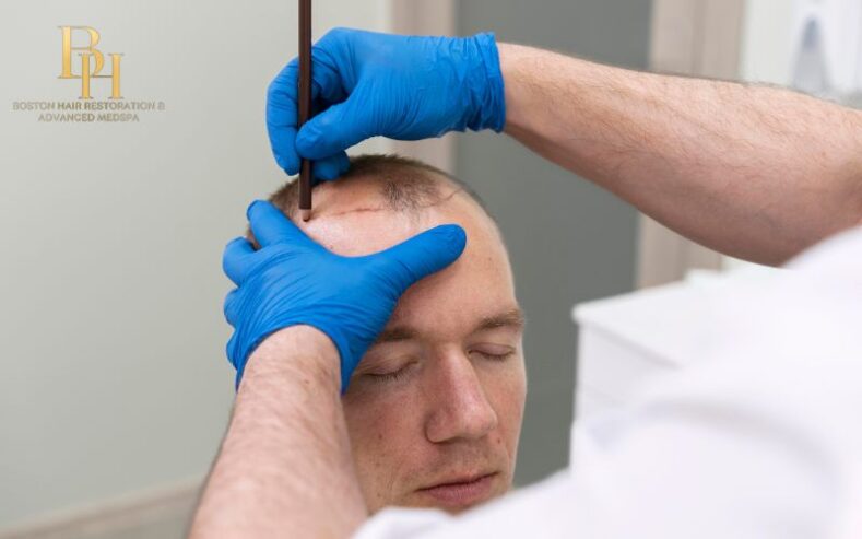 Hair Transplant in Boston: Achieving a Natural Hairline