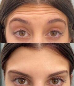 botox