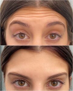 Botox