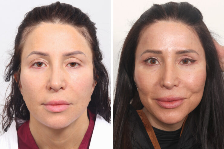Hair Restoration for Women: Restoring Volume and Vitality to Your Hair