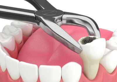 Tooth-Extraction-1024×768-1