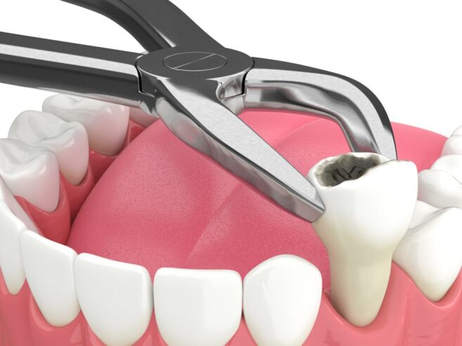 Tooth Extraction in San Antonio, Texas – Dentalhut